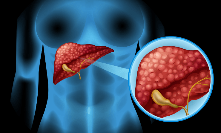Fatty Liver के लिए Best Diet Plan